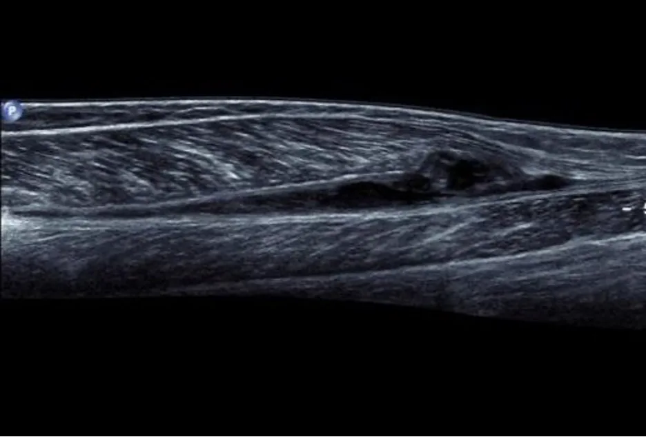 Diagnostic Ultrasound of a medial gastrocnemius tear