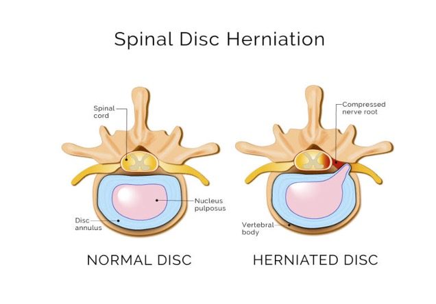 Image showing the anatomy of herniated discs and chiropractic treatment.