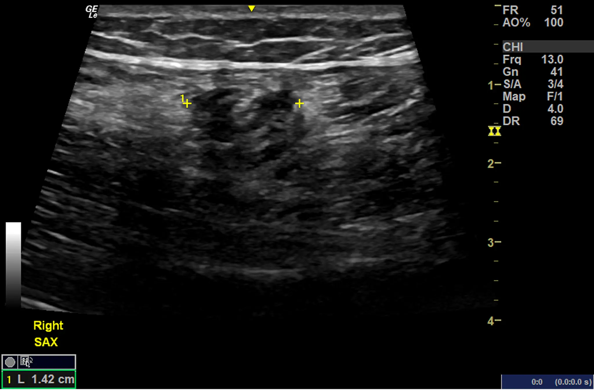 Naturally Healing a Hamstring Strain