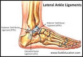 WHAT IS A LATERAL ANKLE SPRAIN?