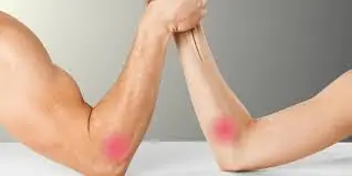 Diagram of elbow anatomy showing medial and lateral epicondyles